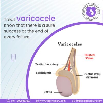 Varicocele is the collection of enlarged veins that occur next to or above one or both testicles.